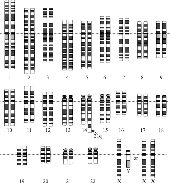Catiotype représentatif du syndrome de down - Human Genome Project